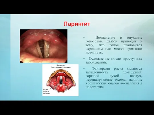 Ларингит Воспаление и опухание голосовых связок приводит к тому, что