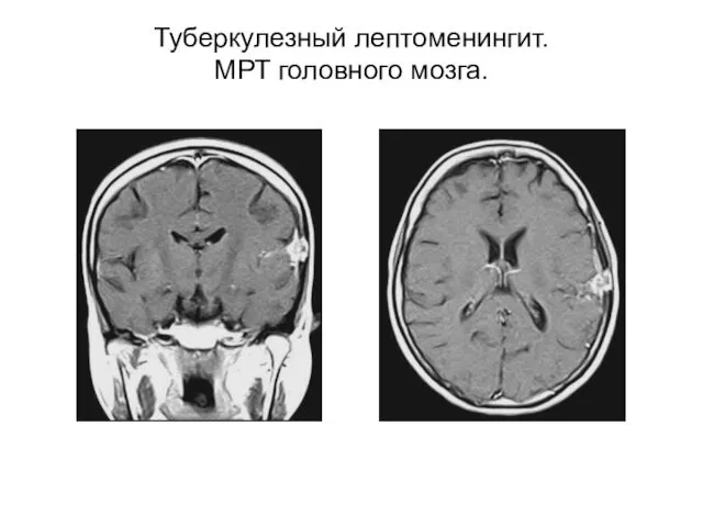 Туберкулезный лептоменингит. МРТ головного мозга.