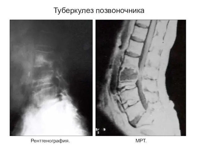 Туберкулез позвоночника Рентгенография. МРТ.