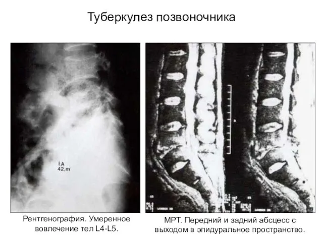 Туберкулез позвоночника Рентгенография. Умеренное вовлечение тел L4-L5. МРТ. Передний и