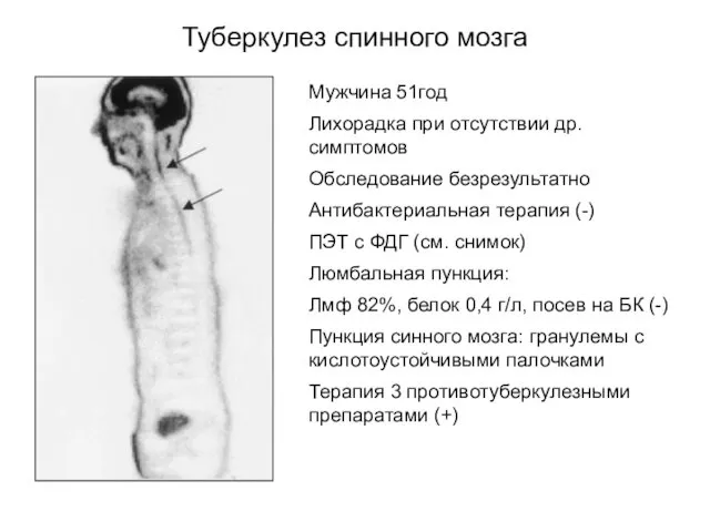 Туберкулез спинного мозга Мужчина 51год Лихорадка при отсутствии др. симптомов