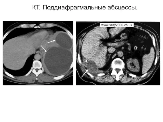 КТ. Поддиафрагмальные абсцессы.