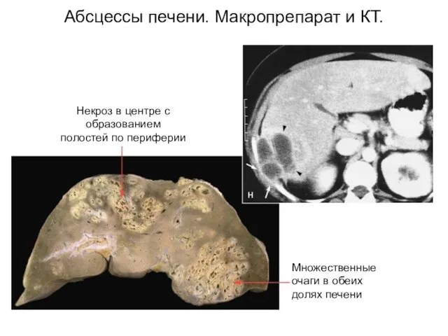 Абсцессы печени. Макропрепарат и КТ.