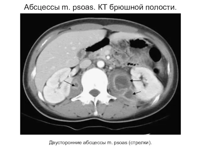 Двусторонние абсцессы m. psoas (стрелки). Абсцессы m. psoas. КТ брюшной полости.