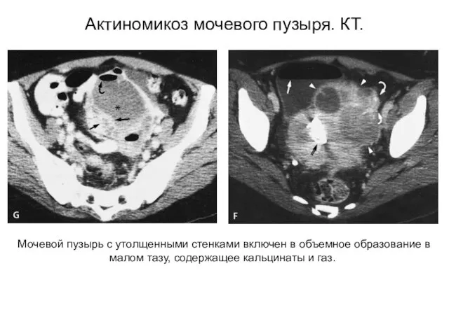 Мочевой пузырь с утолщенными стенками включен в объемное образование в