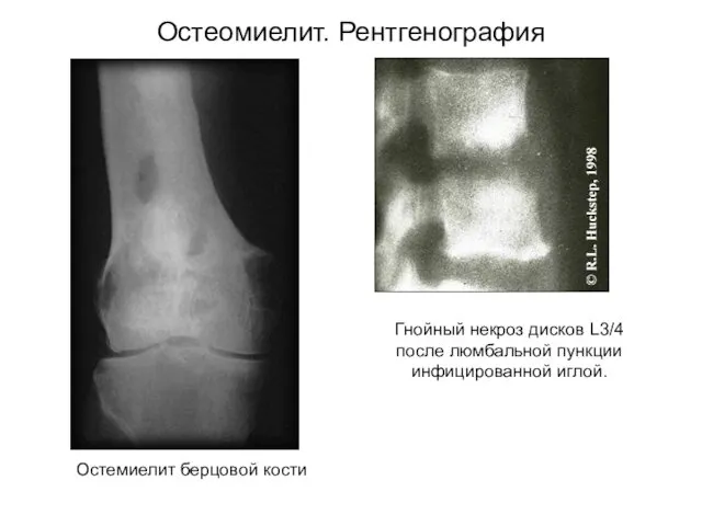 Остеомиелит. Рентгенография Остемиелит берцовой кости Гнойный некроз дисков L3/4 после люмбальной пункции инфицированной иглой.