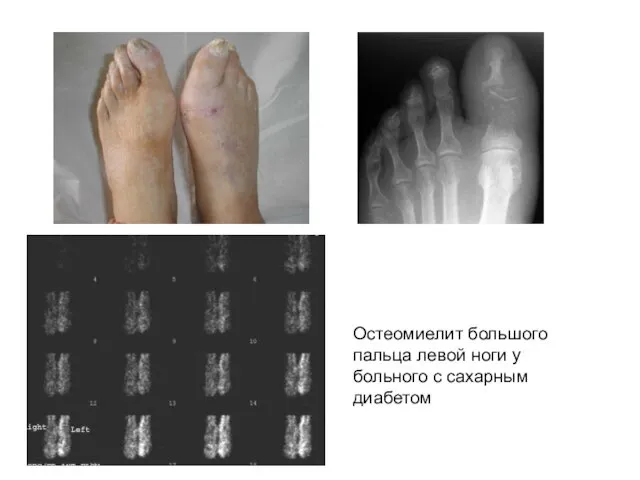 Остеомиелит большого пальца левой ноги у больного с сахарным диабетом