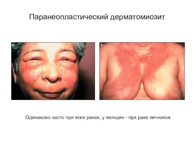 Паранеопластический дерматомиозит Одинаково часто при всех раках, у женщин - при раке яичников