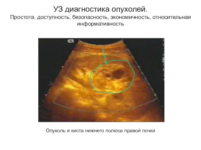 УЗ диагностика опухолей. Простота, доступность, безопасность, экономичность, относительная информативность Опухоль и киста нижнего полюса правой почки