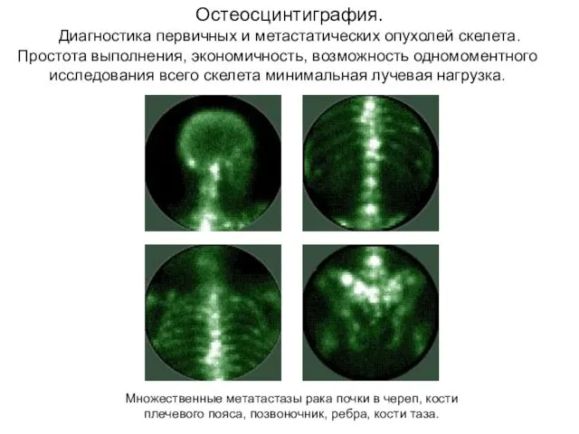 Остеосцинтиграфия. Диагностика первичных и метастатических опухолей скелета. Множественные метатастазы рака