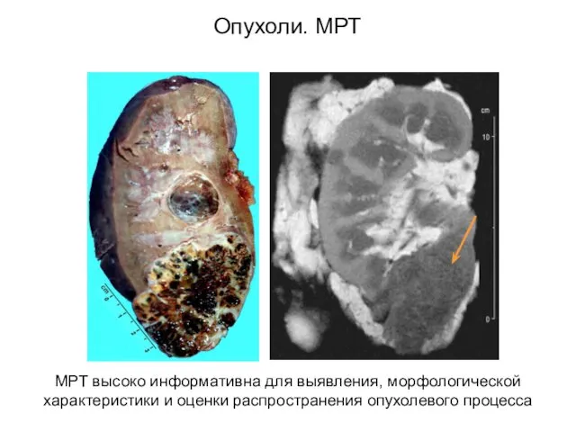 Опухоли. МРТ МРТ высоко информативна для выявления, морфологической характеристики и оценки распространения опухолевого процесса