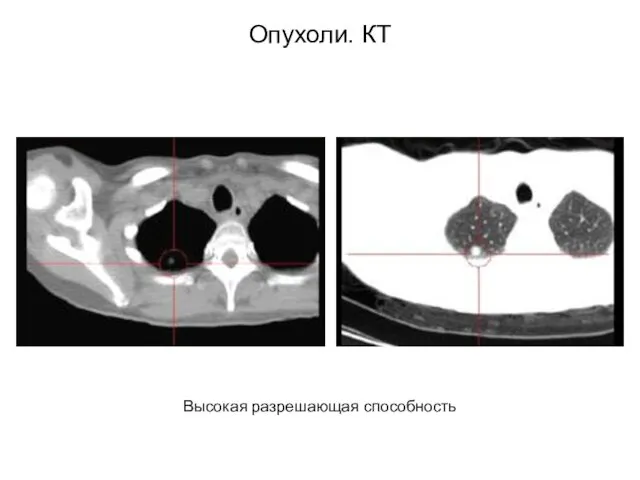 Опухоли. КТ Высокая разрешающая способность