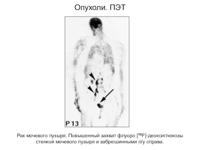 Опухоли. ПЭТ Рак мочевого пузыря. Повышенный захват флуоро [18F]-деоксиглюкозы стенкой мочевого пузыря и забрюшинными л/у справа.