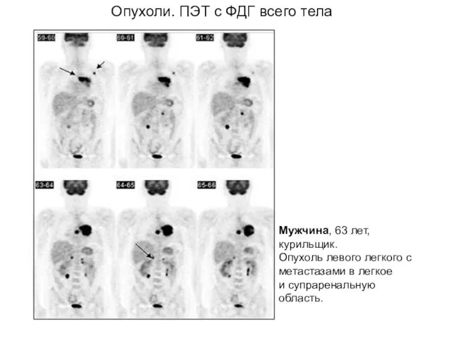 Мужчина, 63 лет, курильщик. Опухоль левого легкого с метастазами в
