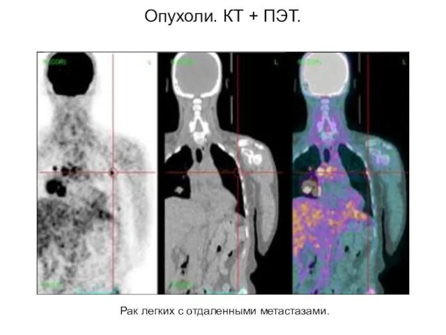 Опухоли. КТ + ПЭТ. Рак легких с отдаленными метастазами.