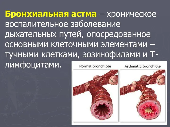 Бронхиальная астма – хроническое воспалительное заболевание дыхательных путей, опосредованное основными