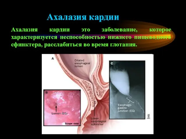 Ахалазия кардии Ахалазия кардии это заболевание, которое характеризуется неспособностью нижнего пищеводного сфинктера, расслабиться во время глотания.