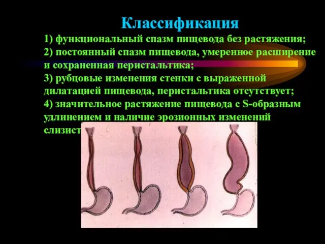 Классификация 1) функциональный спазм пищевода без растяжения; 2) постоянный спазм