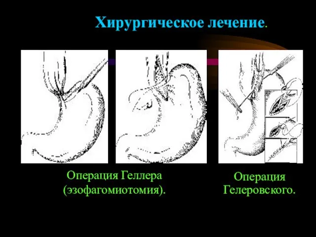 Операция Гелеровского. Хирургическое лечение. Операция Геллера (эзофагомиотомия).