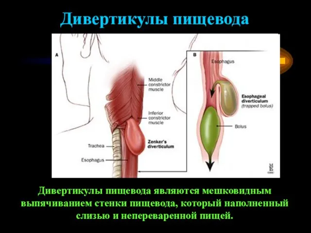 Дивертикулы пищевода Дивертикулы пищевода являются мешковидным выпячиванием стенки пищевода, который наполненный слизью и непереваренной пищей.