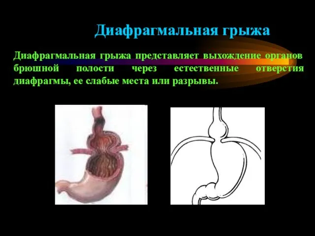 Диафрагмальная грыжа Диафрагмальная грыжа представляет выхождение органов брюшной полости через