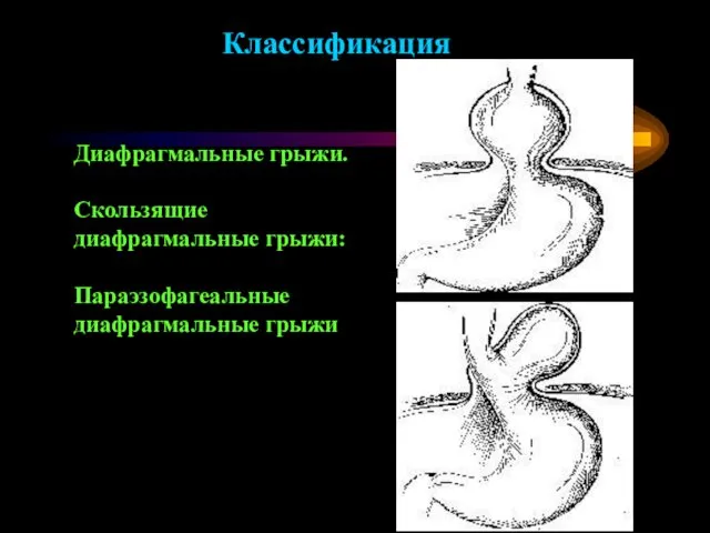 Диафрагмальные грыжи. Скользящие диафрагмальные грыжи: Параэзофагеальные диафрагмальные грыжи Классификация