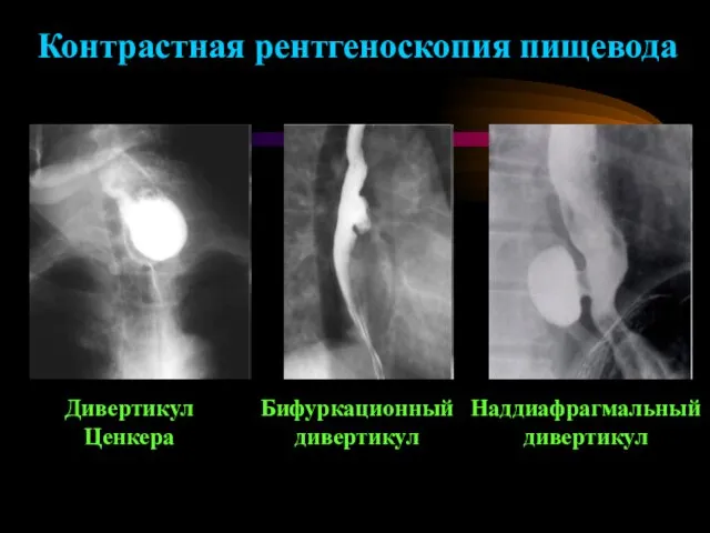 Дивертикул Ценкера Бифуркационный дивертикул Наддиафрагмальный дивертикул Контрастная рентгеноскопия пищевода