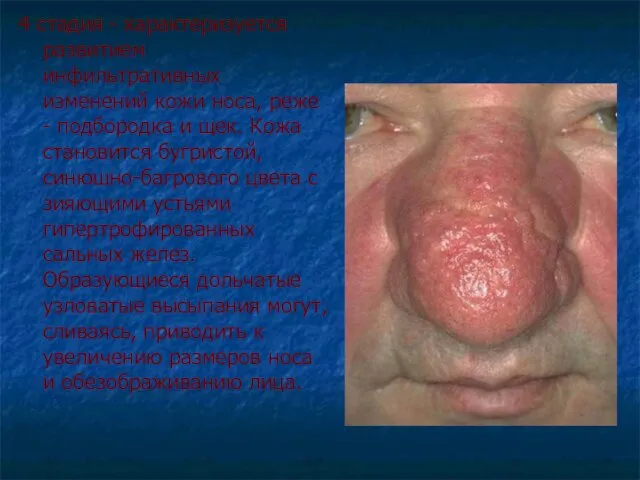 4 стадия - характеризуется развитием инфильтративных изменений кожи носа, реже - подбородка и