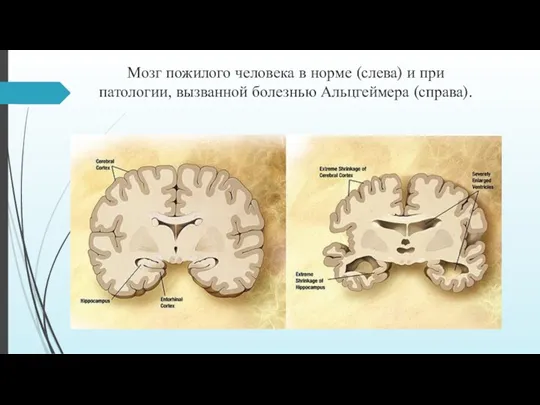 Мозг пожилого человека в норме (слева) и при патологии, вызванной болезнью Альцгеймера (справа).