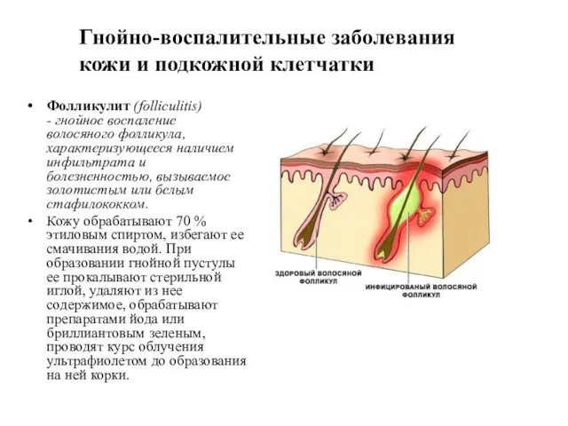 Фолликулит (folliculitis) - гнойное воспаление волосяного фолликула, характеризующееся наличием инфильтрата