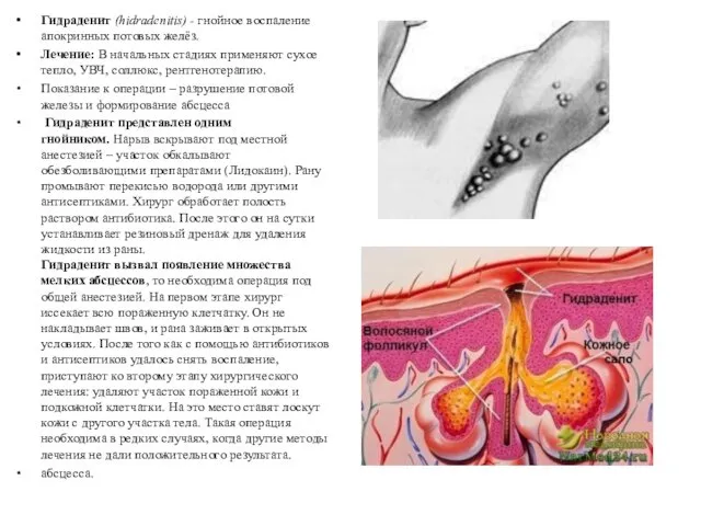 Гидраденит (hidradenitis) - гнойное воспаление апокринных потовых желёз. Лечение: В