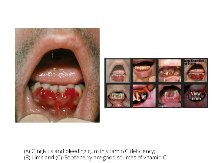 v (A) Gingivitis and bleeding gum in vitamin C deficiency;