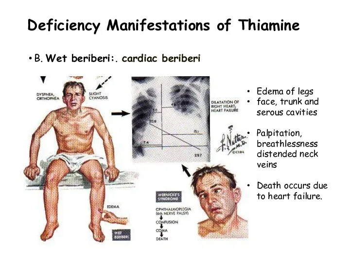 Deficiency Manifestations of Thiamine B. Wet beriberi:. cardiac beriberi Edema