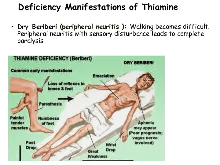 Deficiency Manifestations of Thiamine Dry Beriberi (peripheral neuritis ): Walking