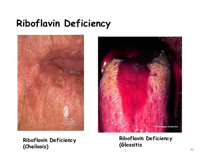 Riboflavin Deficiency Riboflavin Deficiency (Glossitis Riboflavin Deficiency (Cheilosis)