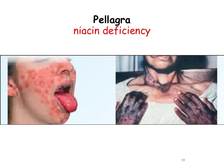 Pellagra niacin deficiency