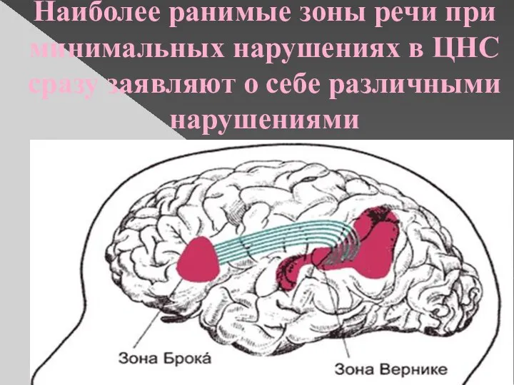 Наиболее ранимые зоны речи при минимальных нарушениях в ЦНС сразу заявляют о себе различными нарушениями