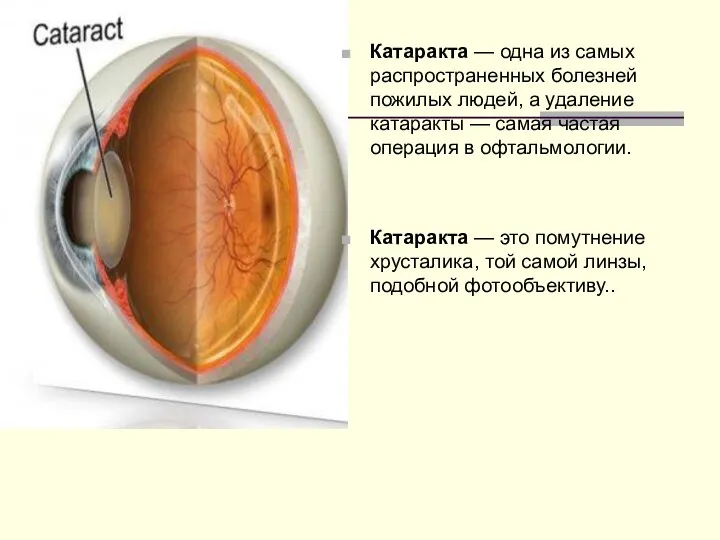 Катаракта — одна из самых распространенных болезней пожилых людей, а