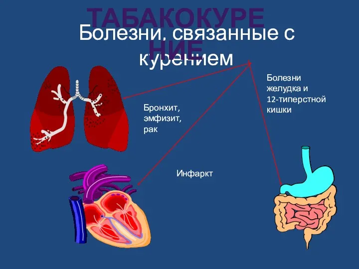 Болезни, связанные с курением Бронхит, эмфизит, рак Инфаркт Болезни желудка и 12-типерстной кишки табакокурение