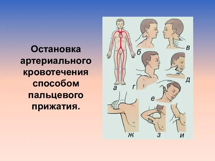 Остановка артериального кровотечения способом пальцевого прижатия.