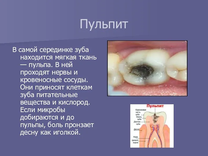 Пульпит В самой серединке зуба находится мягкая ткань — пульпа. В ней проходят