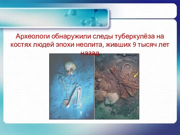 Археологи обнаружили следы туберкулёза на костях людей эпохи неолита, живших 9 тысяч лет назад