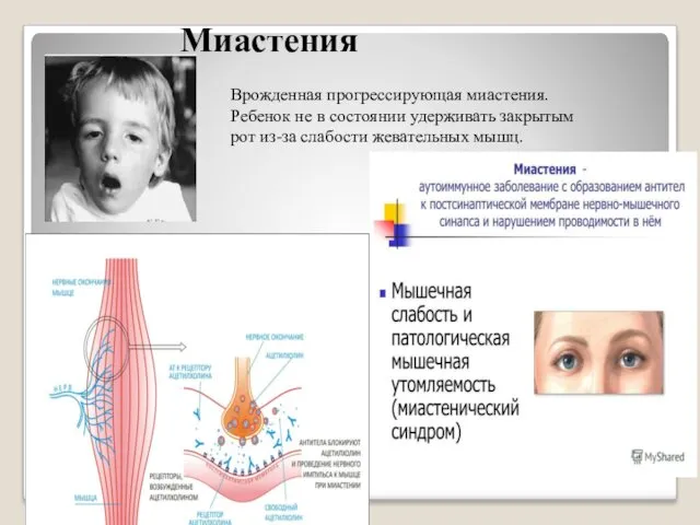 Миастения Врожденная прогрессирующая миастения. Ребенок не в состоянии удерживать закрытым рот из-за слабости жевательных мышц.