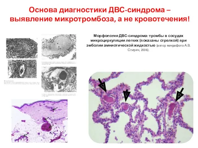 Морфология ДВС-синдрома: тромбы в сосудах микроциркуляции легких (показаны стрелкой) при