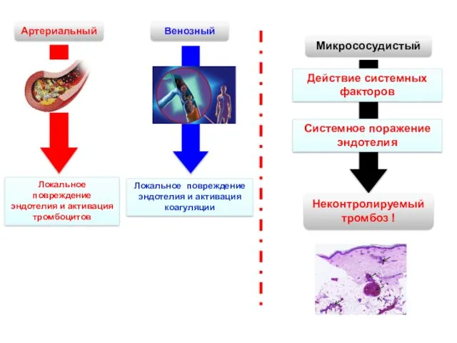 Локальное повреждение эндотелия и активация тромбоцитов Локальное повреждение эндотелия и активация коагуляции Артериальный