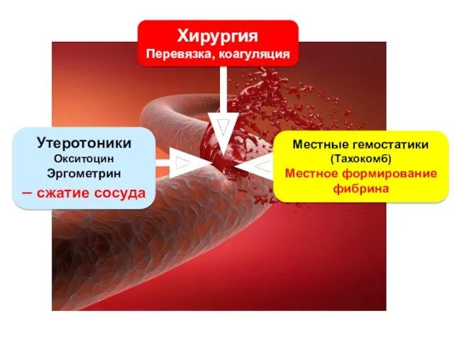 Хирургия Перевязка, коагуляция Местные гемостатики (Тахокомб) Местное формирование фибрина Утеротоники Окситоцин Эргометрин – сжатие сосуда