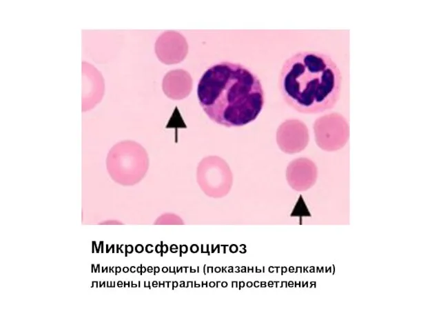 Микросфероцитоз Микросфероциты (показаны стрелками) лишены центрального просветления