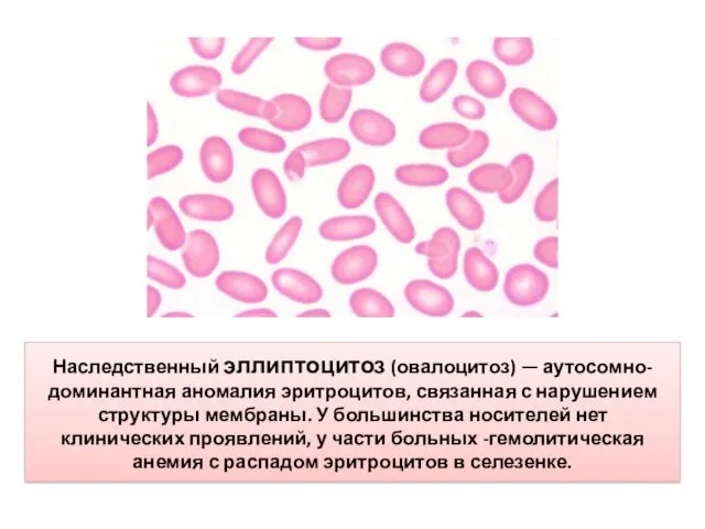 Наследственный эллиптоцитоз (овалоцитоз) — аутосомно-доминантная аномалия эритроцитов, связанная с нарушением