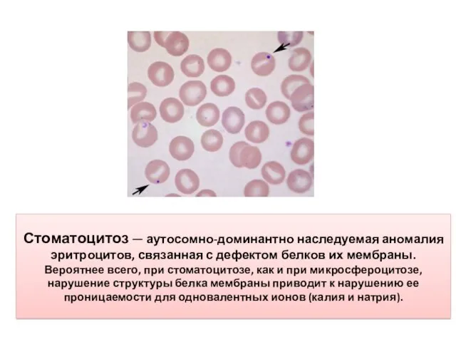 Стоматоцитоз — аутосомно-доминантно наследуемая аномалия эритроцитов, связанная с дефектом белков