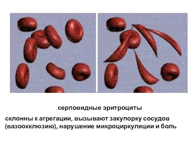 серповидные эритроциты склонны к агрегации, вызывают закупорку сосудов (вазоокклюзию), нарушение микроциркуляции и боль